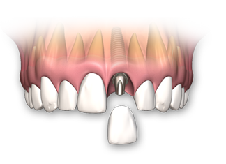 single-tooth-implant